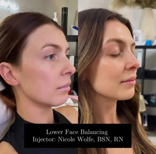 dermal-fillers-before-and-after (16)