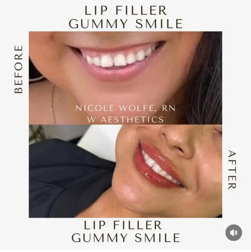 dermal-fillers-before-and-after (24)