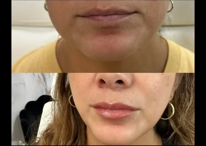 dermal-fillers-before-and-after (30)