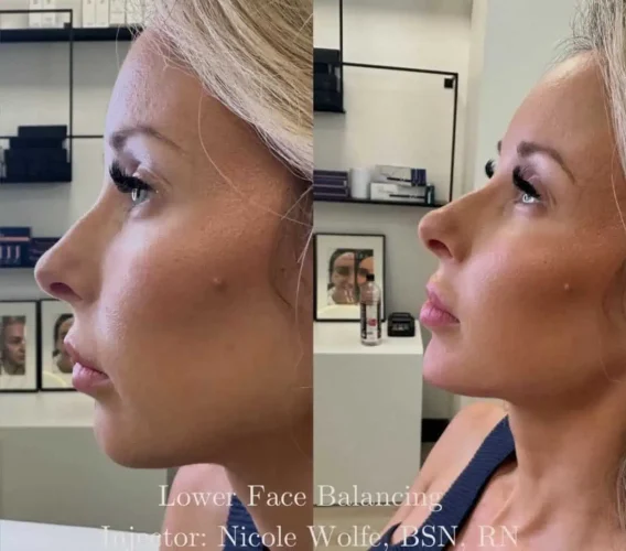 dermal-fillers-before-and-after (31)