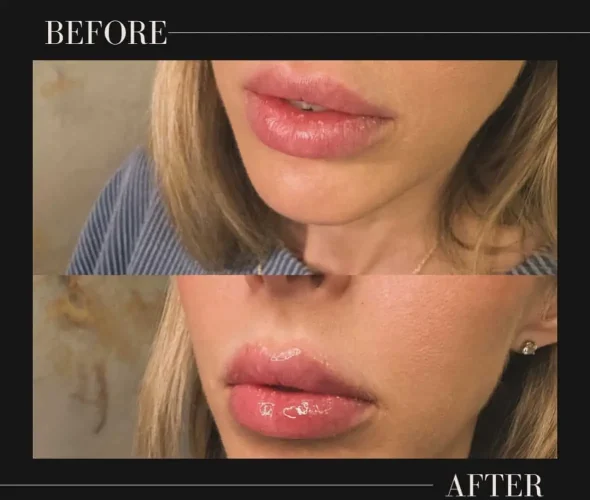 dermal-fillers-before-and-after (38)