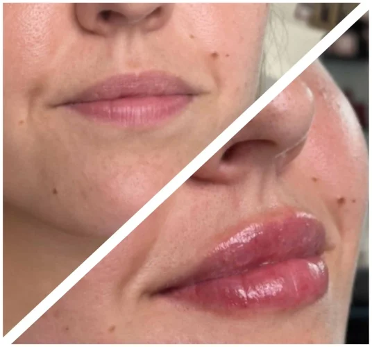 dermal-fillers-before-and-after (39)