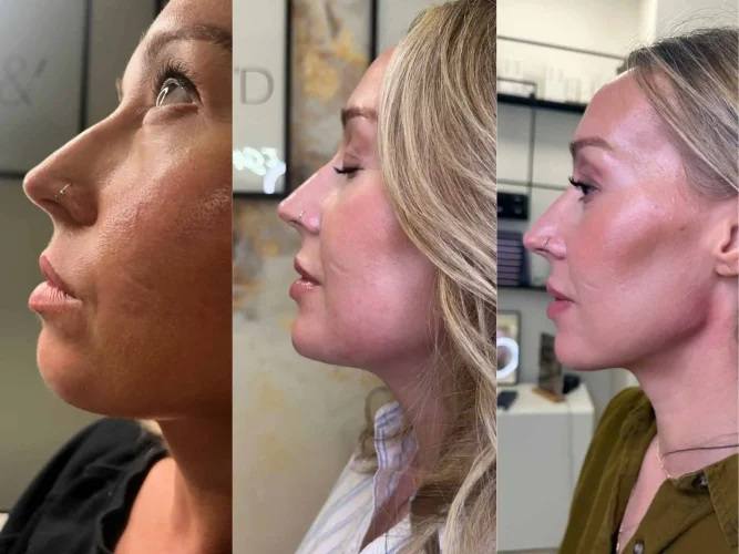 dermal-fillers-before-and-after (41)