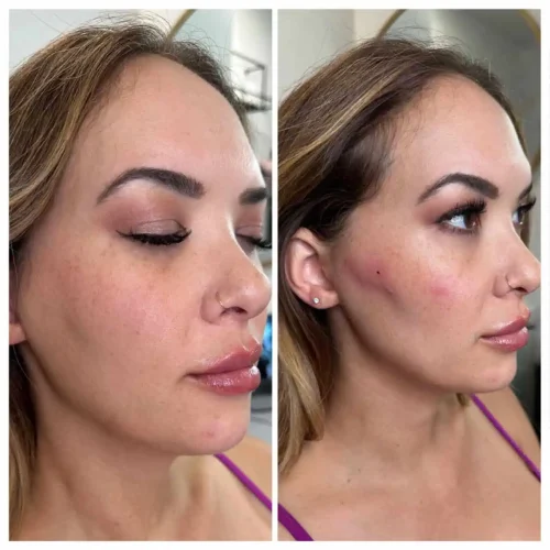 dermal-fillers-before-and-after (8)